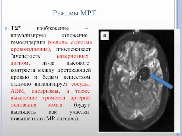 Режимы МРТ Т2* изображение – визуализирует отложение гемосидерина (мелкие, скрытые кровоизлияния),