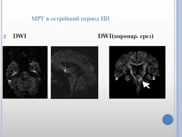 МРТ в острейший период ИИ DWI DWI(коронар. срез)
