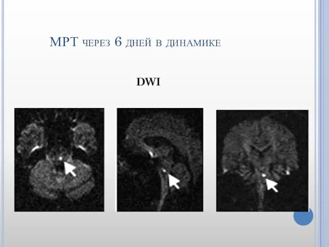 МРТ через 6 дней в динамике DWI