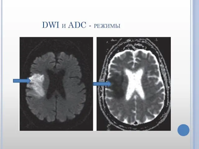 DWI и ADC - режимы