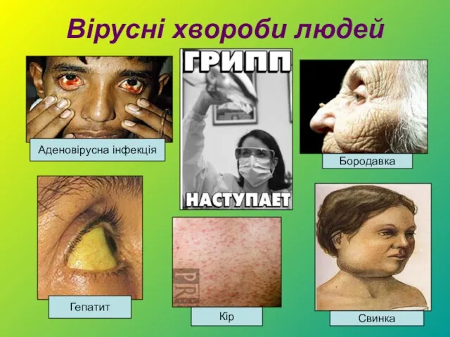 Вірусні хвороби людей Кір Бородавка Гепатит Аденовірусна інфекція Свинка