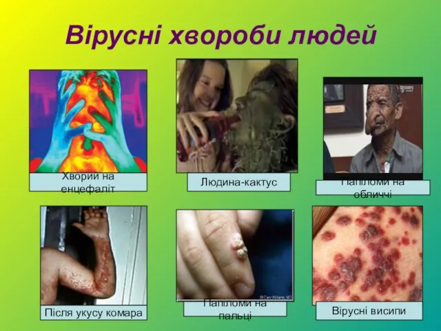 Вірусні хвороби людей Хворий на енцефаліт Людина-кактус Після укусу комара Папіломи