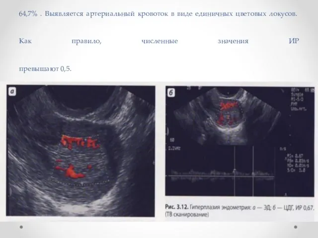Васкуляризация эндометрия при гиперплазии по данным различных авторов колеблется от 12