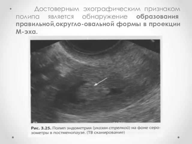 Достоверным эхографическим признаком поли­па является обнаружение образования правильной,округло-овальной формы в проекции М-эха.