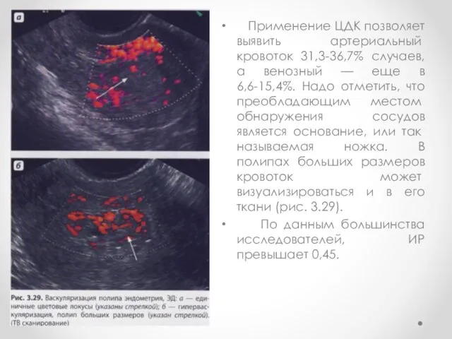 Применение ЦДК позволяет выявить артериаль­ный кровоток 31,3-36,7% случаев, а венозный —