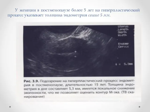 У женщин в постменопаузе более 5 лет на гиперпластический процесс указывает толщина эндометрия свыше 5 мм.