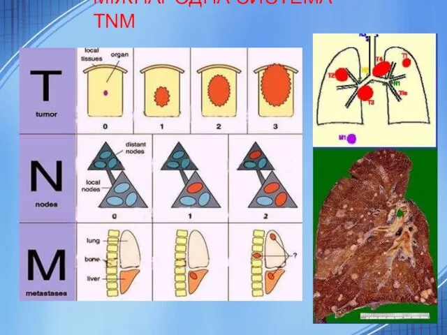 МІЖНАРОДНА СИСТЕМА TNM