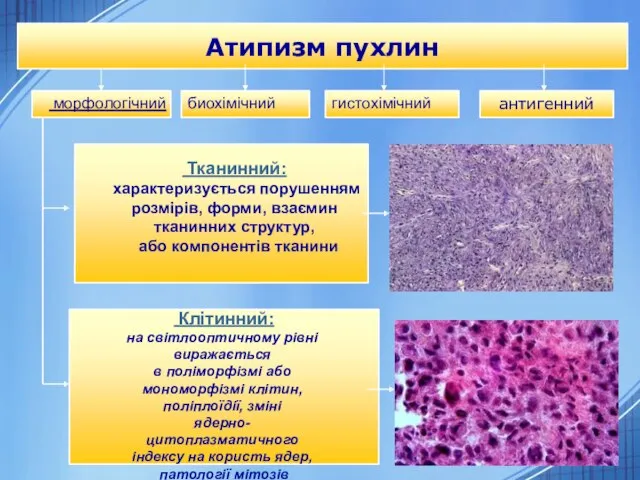 Атипизм пухлин Клітинний: на світлооптичному рівні виражається в поліморфізмі або мономорфізмі