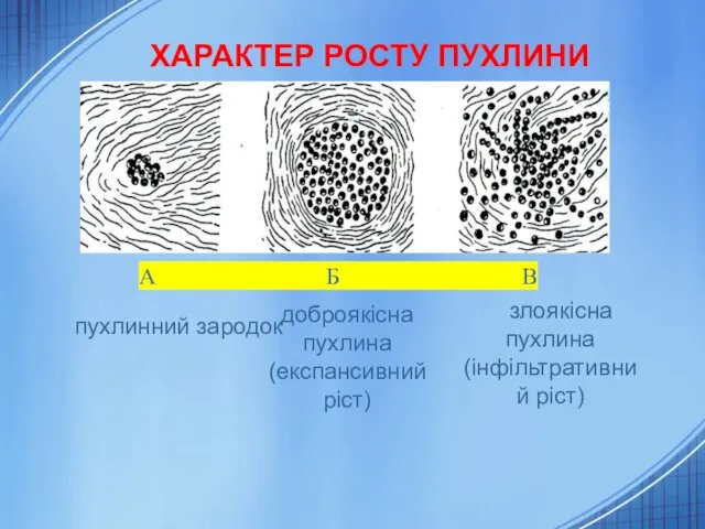 ХАРАКТЕР РОСТУ ПУХЛИНИ А Б В злоякісна пухлина (інфільтративний ріст) пухлинний зародок доброякісна пухлина (експансивний ріст)