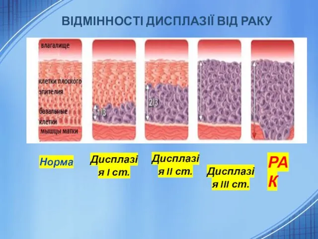 ВІДМІННОСТІ ДИСПЛАЗІЇ ВІД РАКУ РАК Норма Дисплазія I ст. Дисплазія II ст. Дисплазія III ст.