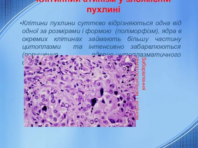 Клітинний атипізм у злоякісній пухлині Клітини пухлини суттєво відрізняються одна від