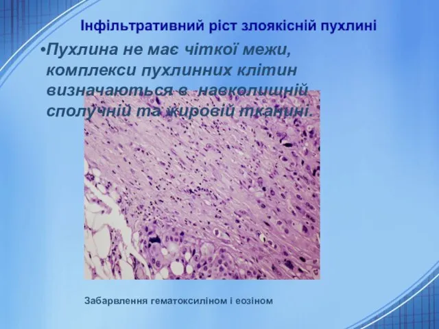 Забарвлення гематоксиліном і еозіном Пухлина не має чіткої межи, комплекси пухлинних