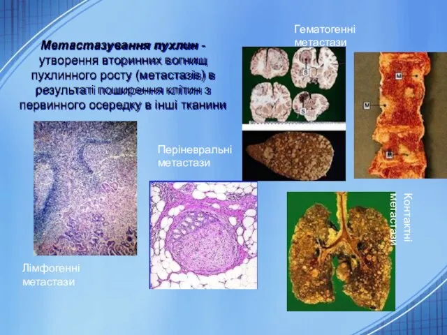 Метастазування пухлин - утворення вторинних вогнищ пухлинного росту (метастазів) в результаті