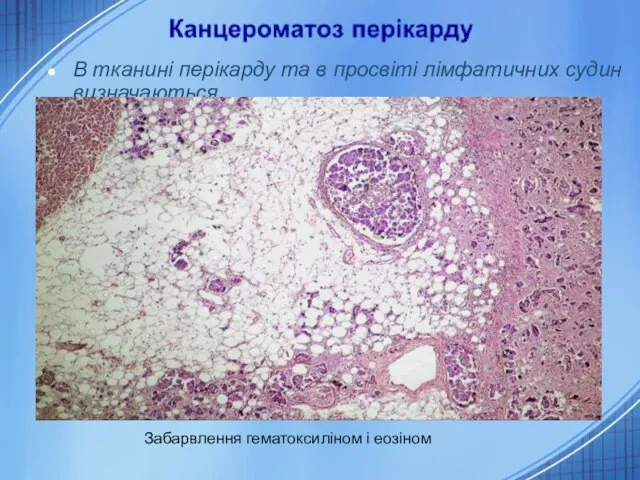 В тканині перікарду та в просвіті лімфатичних судин визначаються комплекси атипових