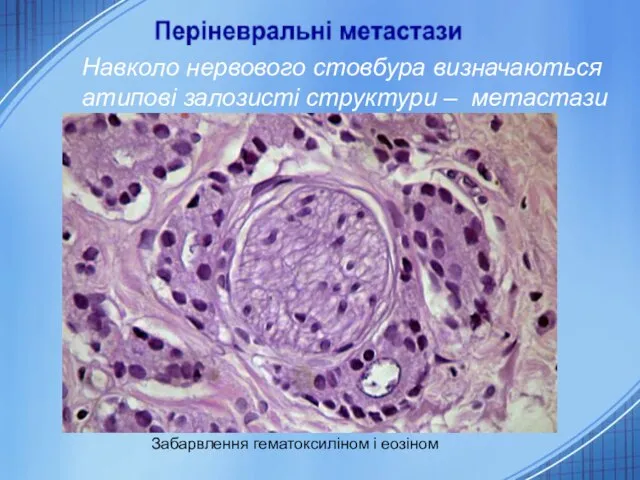 Навколо нервового стовбура визначаються атипові залозисті структури – метастази аденокарциноми. Забарвлення гематоксиліном і еозіном