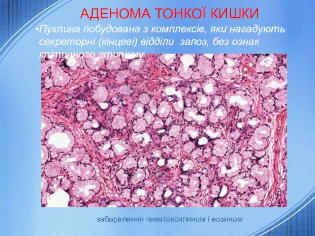 АДЕНОМА ТОНКОЇ КИШКИ Пухлина побудована з комплексів, яки нагадують секреторні (кінцеві)