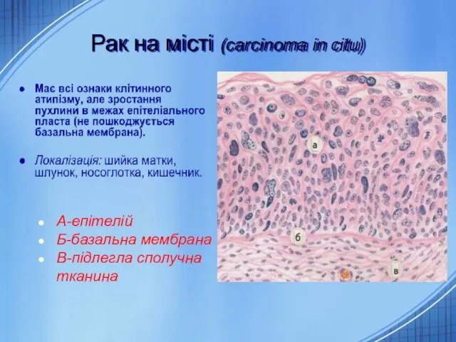 Рак на місті (carcinoma in citu) А-епітелій Б-базальна мембрана В-підлегла сполучна тканина