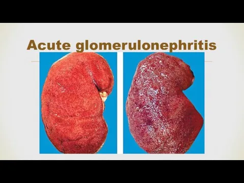 Acute glomerulonephritis