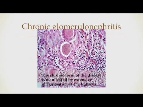 Chronic glomerulonephritis