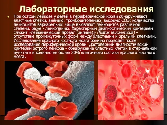 Лабораторные исследования При остром лейкозе у детей в периферической крови обнаруживают