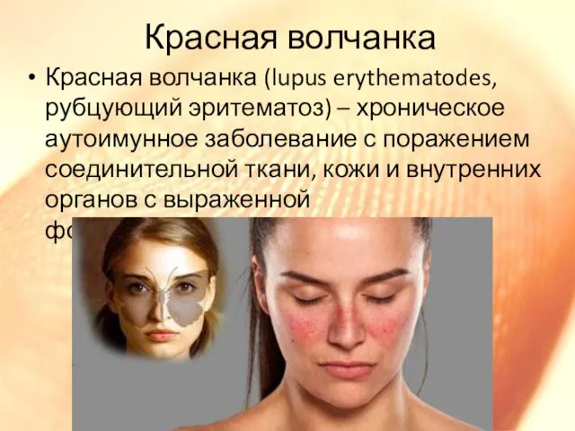 Красная волчанка Красная волчанка (lupus erythematodes, рубцующий эритематоз) – хроническое аутоимунное