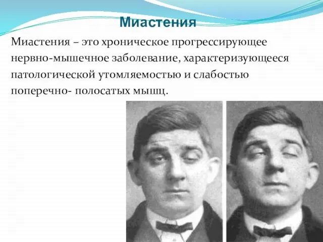 Миастения – это хроническое прогрессирующее нервно-мышечное заболевание, характеризующееся патологической утомляемостью и слабостью поперечно- полосатых мышц. Миастения