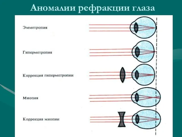 Аномалии рефракции глаза