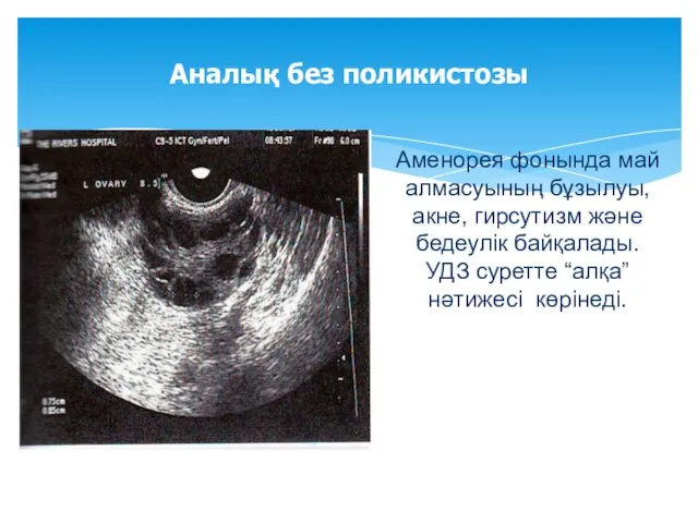 Аналық без поликистозы Аменорея фонында май алмасуының бұзылуы, акне, гирсутизм және