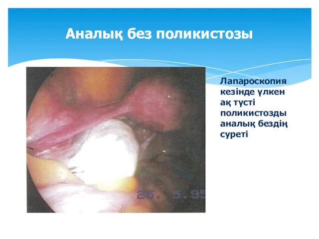 Аналық без поликистозы Лапароскопия кезінде үлкен ақ түсті поликистозды аналық бездің суреті