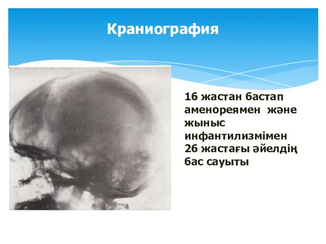 Краниография 16 жастан бастап аменореямен және жыныс инфантилизмімен 26 жастағы әйелдің бас сауыты