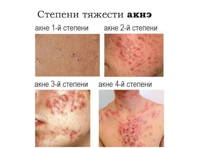 Степени тяжести акнэ