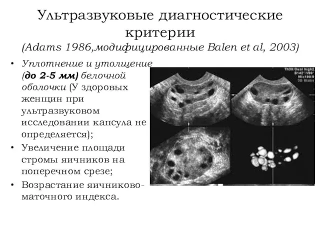 Ультразвуковые диагностические критерии (Adams 1986,модифицированные Balen et al, 2003) Уплотнение и