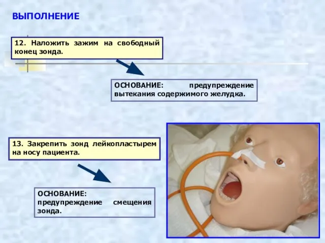 13. Закрепить зонд лейкопластырем на носу пациента. ВЫПОЛНЕНИЕ 12. Наложить зажим