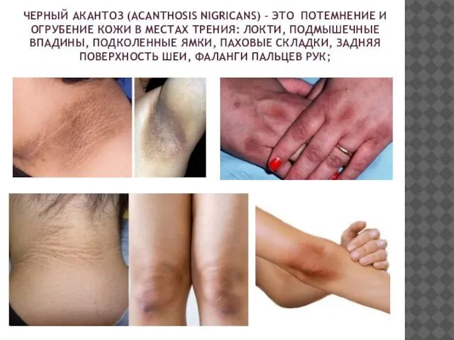 ЧЕРНЫЙ АКАНТОЗ (ACANTHOSIS NIGRICANS) – ЭТО ПОТЕМНЕНИЕ И ОГРУБЕНИЕ КОЖИ В