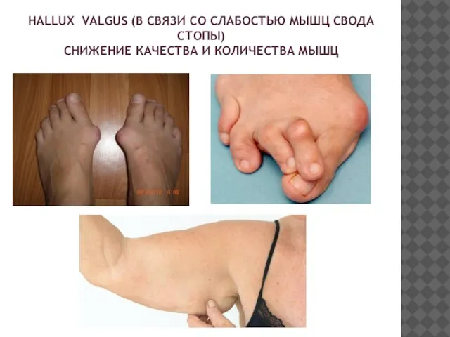 HALLUX VALGUS (В СВЯЗИ СО СЛАБОСТЬЮ МЫШЦ СВОДА СТОПЫ) СНИЖЕНИЕ КАЧЕСТВА И КОЛИЧЕСТВА МЫШЦ