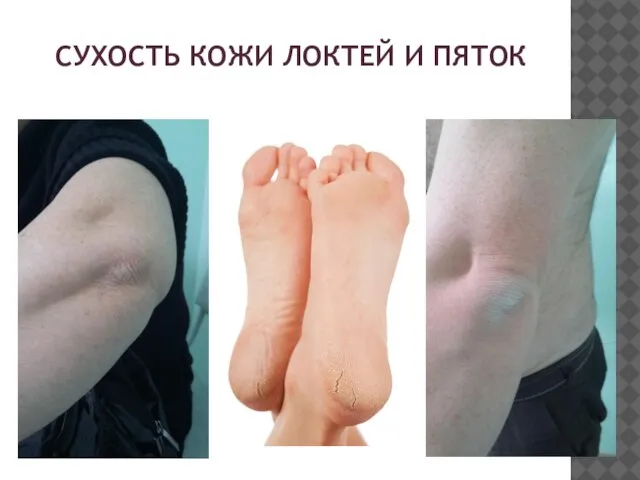 СУХОСТЬ КОЖИ ЛОКТЕЙ И ПЯТОК