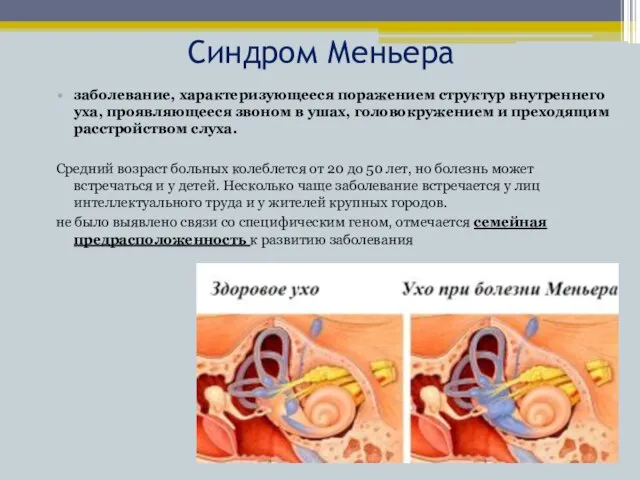 Синдром Меньера заболевание, характеризующееся поражением структур внутреннего уха, проявляющееся звоном в