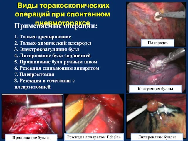 Виды торакоскопических операций при спонтанном пневмотораксе Применяемые операции: 1. Только дренирование