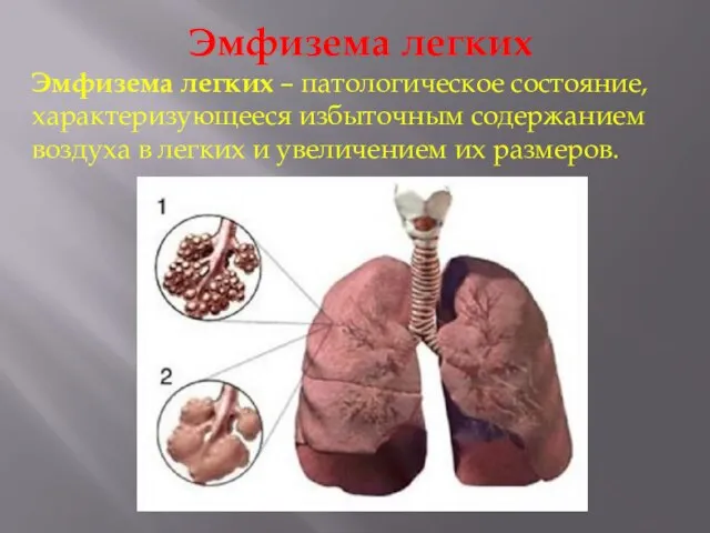 Эмфизема легких Эмфизема легких – патологическое состояние, характеризующееся избыточным содержанием воздуха