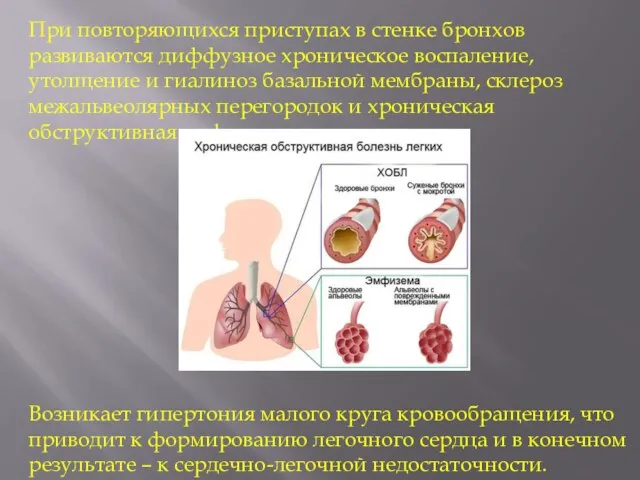 При повторяющихся приступах в стенке бронхов развиваются диффузное хроническое воспаление, утолщение