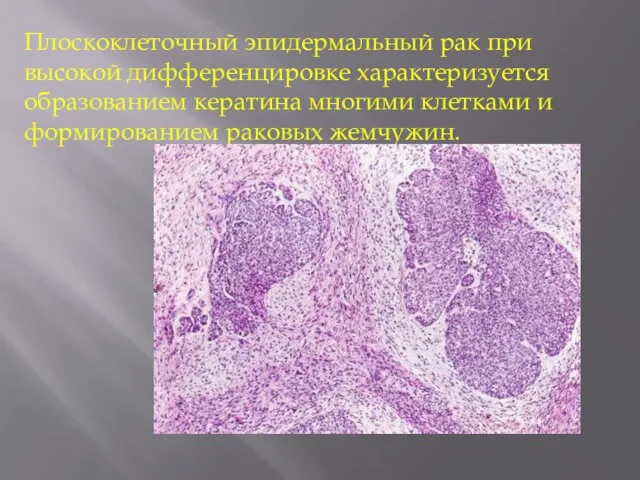 Плоскоклеточный эпидермальный рак при высокой дифференцировке характеризуется образованием кератина многими клетками и формированием раковых жемчужин.