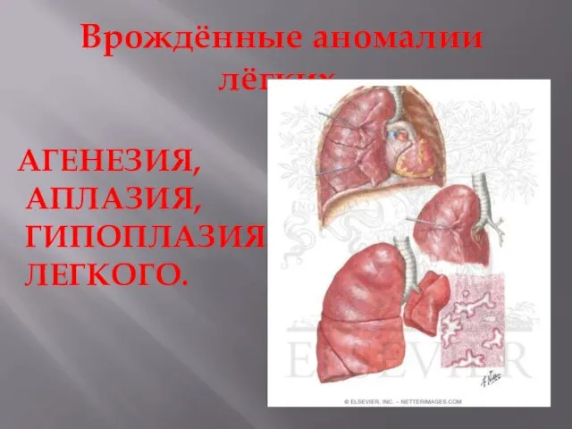 Врождённые аномалии лёгких. АГЕНЕЗИЯ, АПЛАЗИЯ, ГИПОПЛАЗИЯ ЛЕГКОГО.