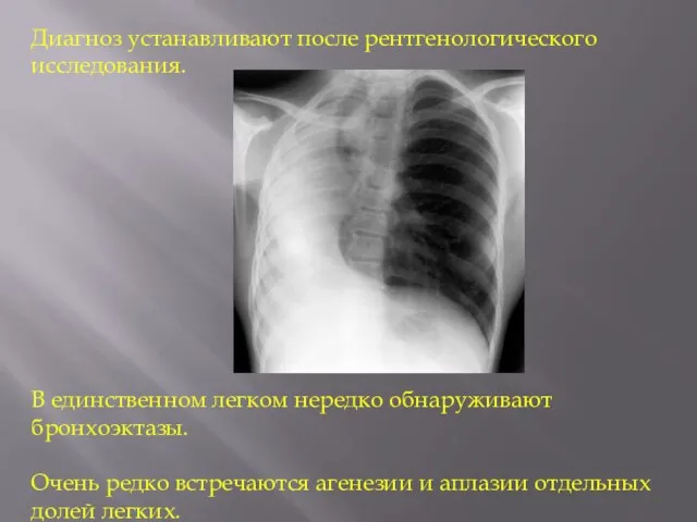 Диагноз устанавливают после рентгенологического исследования. В единственном легком нередко обнаруживают бронхоэктазы.