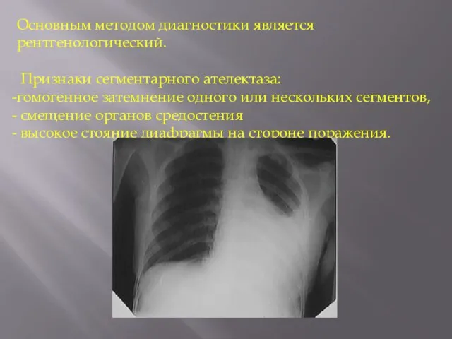 Основным методом диагностики является рентгенологический. Признаки сегментарного ателектаза: гомогенное затемнение одного