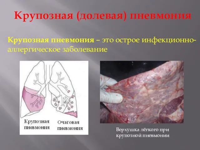 Крупозная (долевая) пневмония Крупозная пневмония – это острое инфекционно-аллергическое заболевание Верхушка лёгкого при крупозной пневмонии