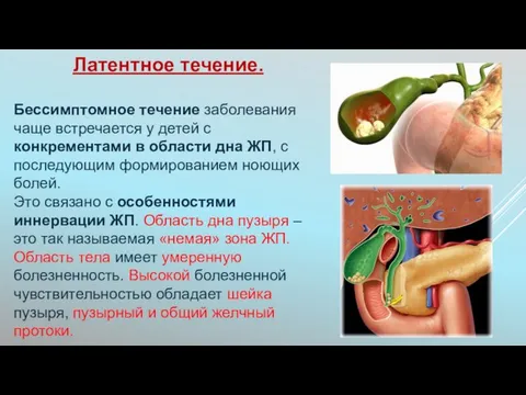 Латентное течение. Бессимптомное течение заболевания чаще встречается у детей с конкрементами