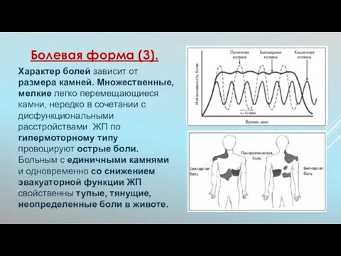 Характер болей зависит от размера камней. Множественные, мелкие легко перемещающиеся камни,