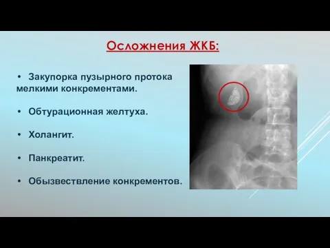 Закупорка пузырного протока мелкими конкрементами. Обтурационная желтуха. Холангит. Панкреатит. Обызвествление конкрементов. Осложнения ЖКБ: