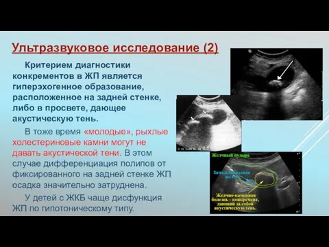 Ультразвуковое исследование (2) Критерием диагностики конкрементов в ЖП является гиперэхогенное образование,