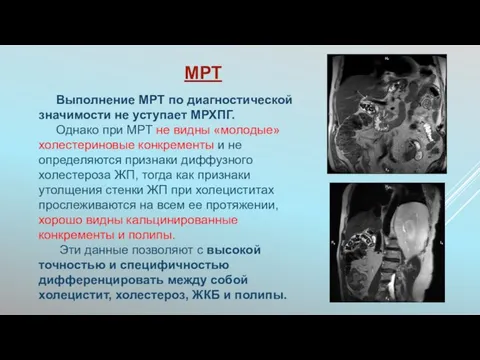 МРТ Выполнение МРТ по диагностической значимости не уступает МРХПГ. Однако при